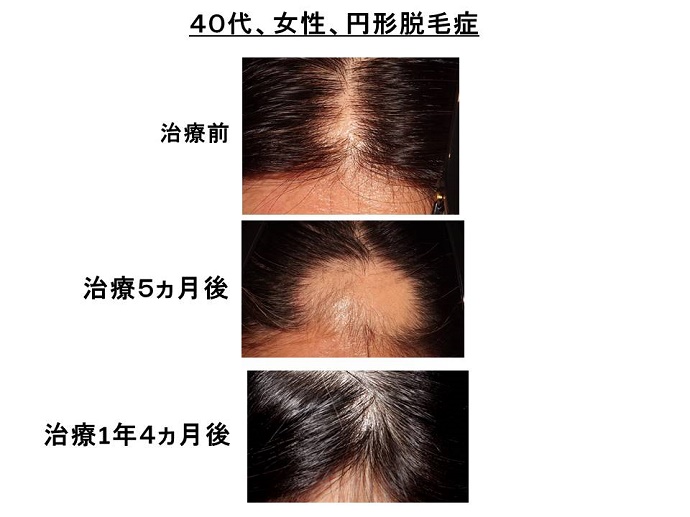 円形脱毛症　病院